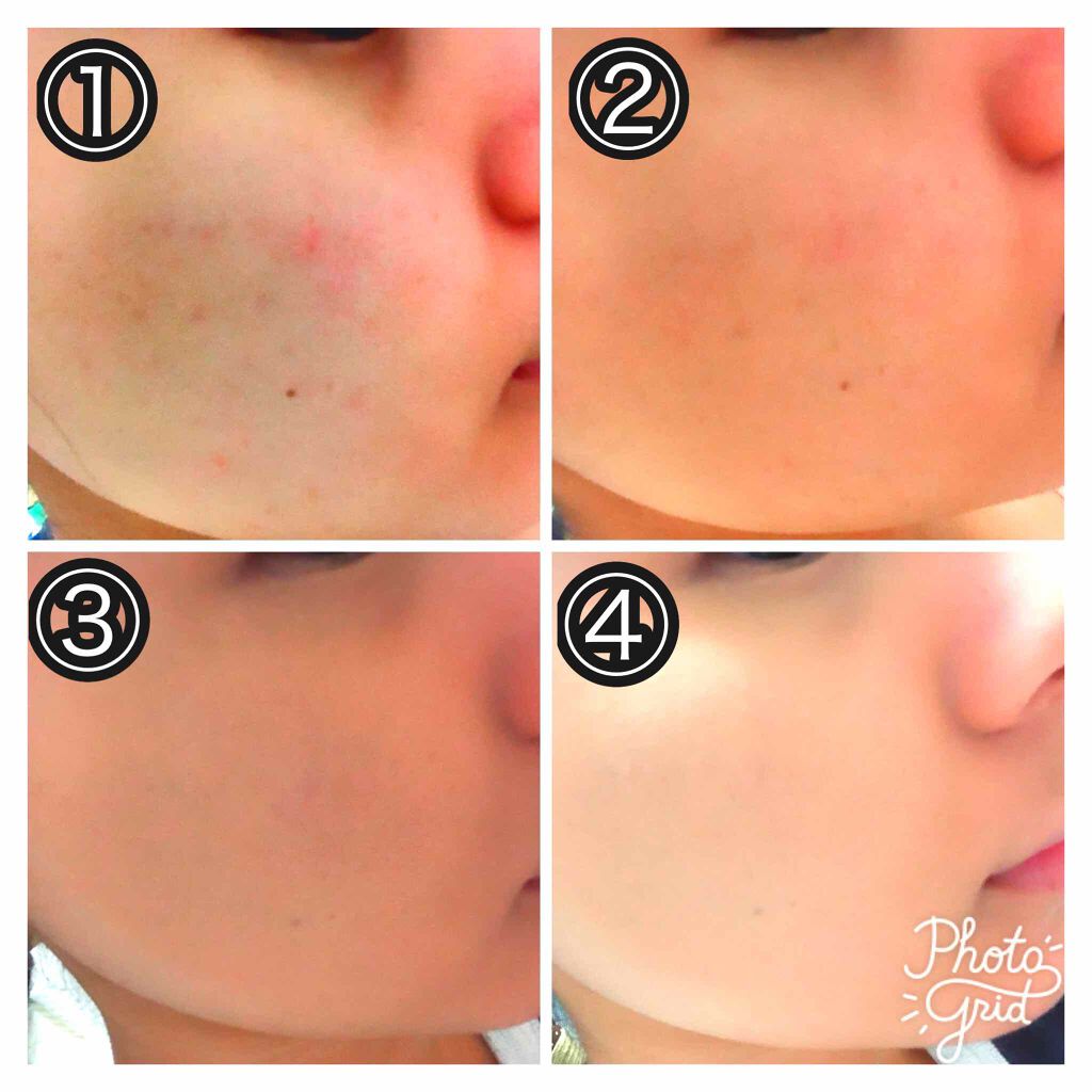 スポッツカバー ファウンデイション/SHISEIDO/クリームコンシーラーを使ったクチコミ(1枚目)