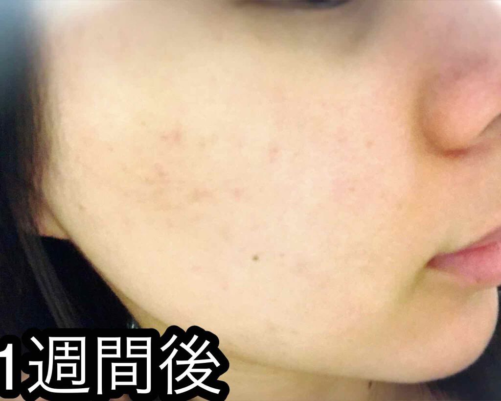 オーガニック炭酸ホワイトパック/Sing/洗い流すパック・マスクを使ったクチコミ（2枚目）