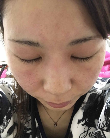 さいきa 保水治療ローション(医薬品)/Saiki/その他を使ったクチコミ(3枚目)