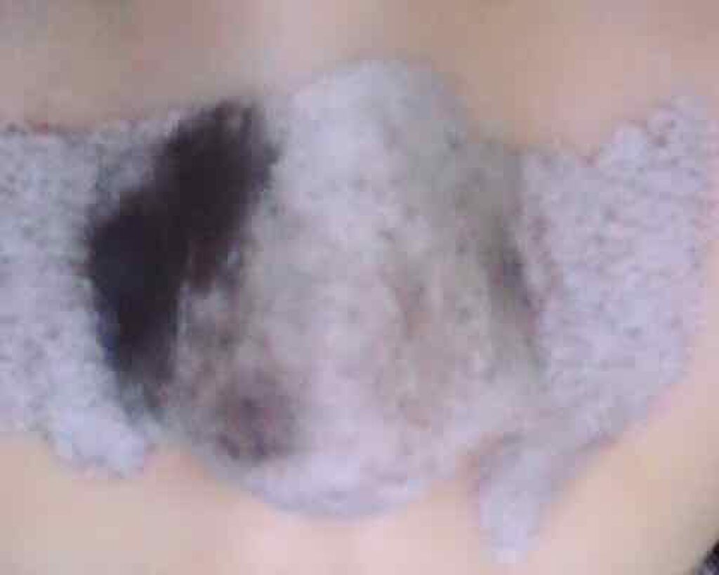 ツルリ 皮脂吸い出し 部分用パック ガスール&レッドパワー/ツルリ/洗い流すパック・マスクを使ったクチコミ(2枚目)