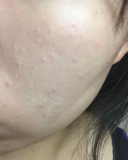 エトヴォス マットスムースミネラルファンデーションのクチコミ「⚠️閲覧注意⚠️
NO加工のため、とても肌荒れしています。
ETVOSの『マットムースミ.....」(3枚目)