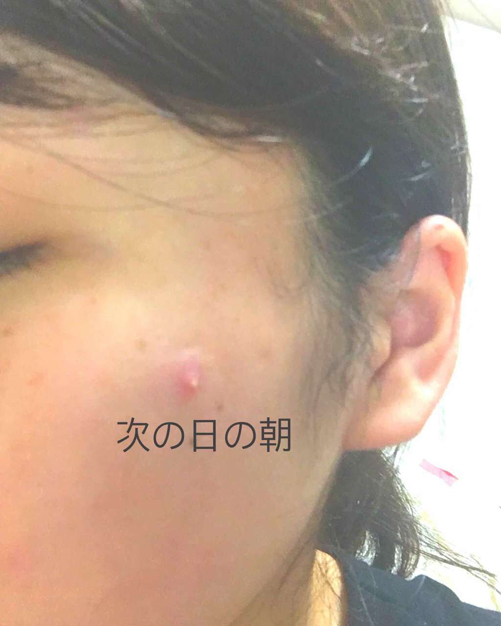 ひよっこ on LIPS 「【ニキビ画像あり】ちょうど痛いタイプのニキビができてしまって😭..」(3枚目)