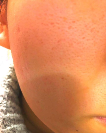 オードムーゲ 薬用ローション(ふきとり化粧水)/オードムーゲ/拭き取り化粧水を使ったクチコミ(2枚目)