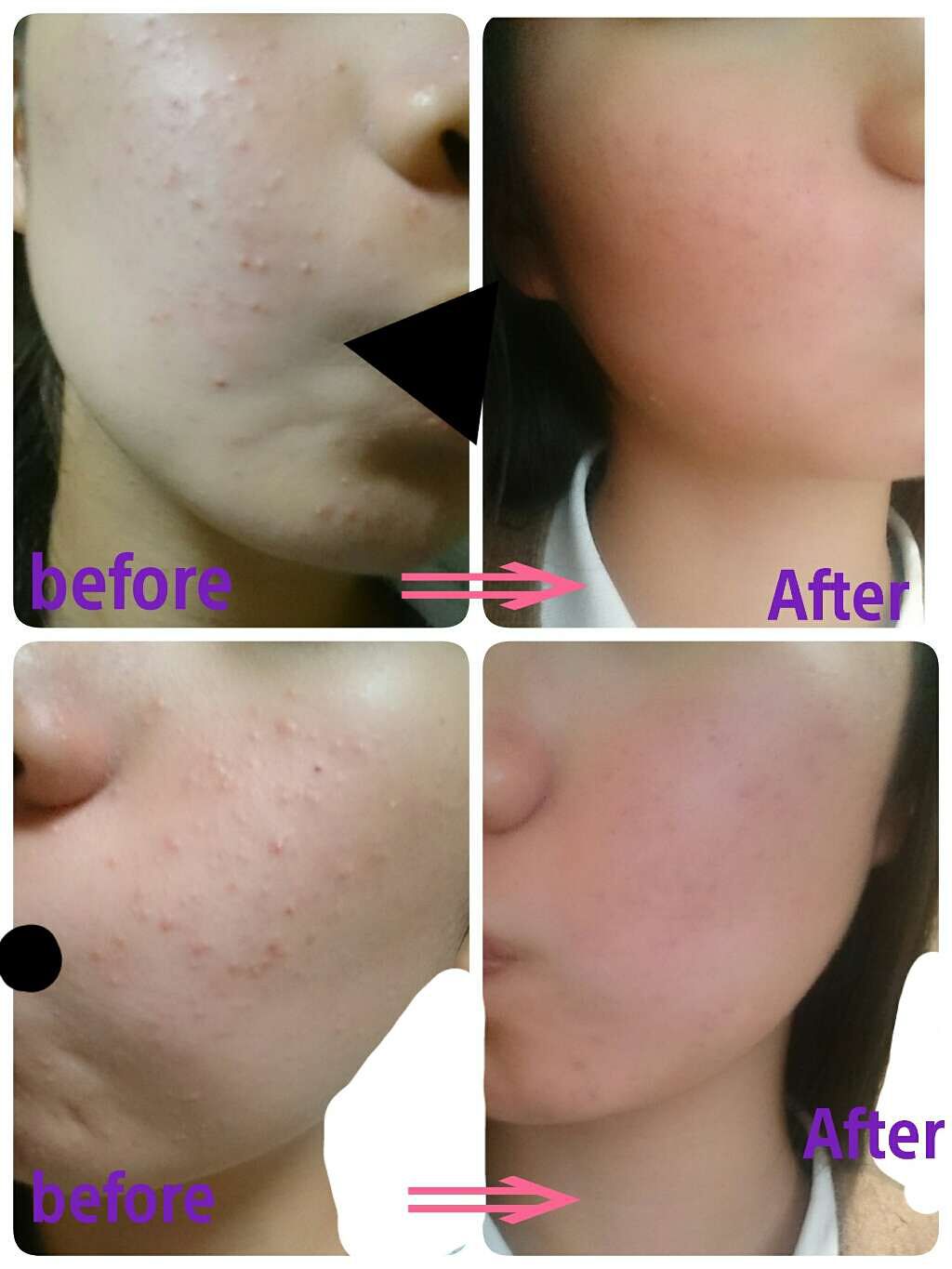 ニキビ治療薬(医薬品)/メンソレータム アクネス/その他を使ったクチコミ(4枚目)