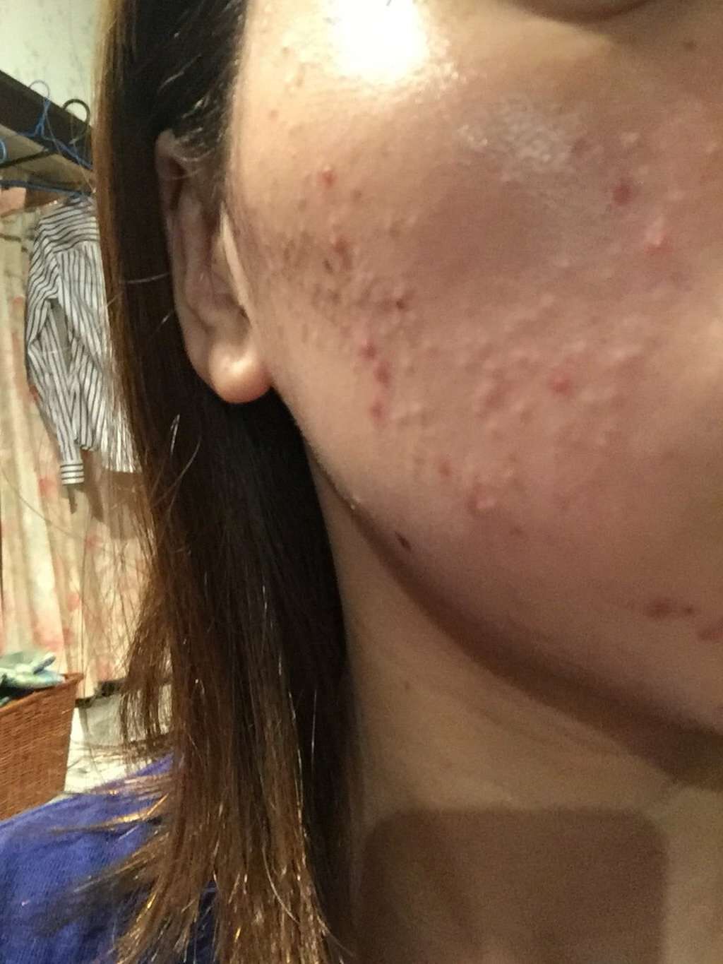 アクネケア&美白水/アクアレーベル/化粧水を使ったクチコミ(3枚目)