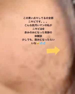 ペアA錠 (医薬品)/ペア/その他を使ったクチコミ(1枚目)