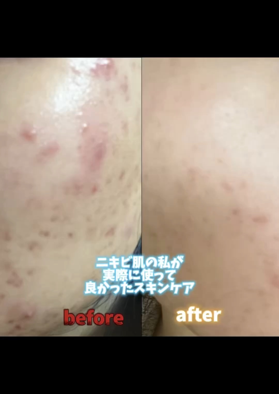 ダーマレーザー ウルセラAZ/クオリティファースト/美容液の人気ショート動画