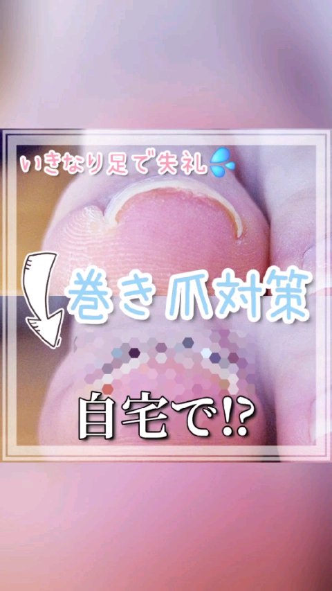 Ingrown Toenails Correction Wire/jinail/ネイル用品の動画クチコミ1つ目