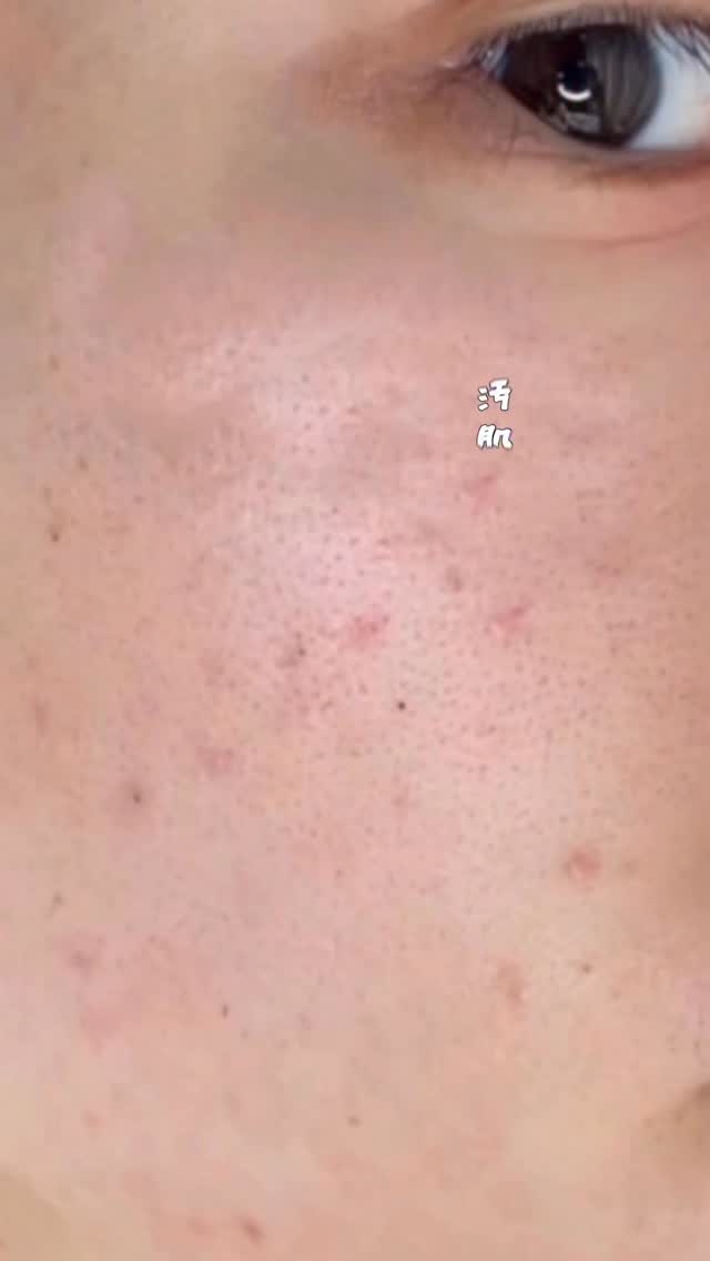 汚肌から美肌になれるスキンケア。

ずっと言い続けてきた「ふきとりケア」の習慣が、僕を変えてくれました。

どんなに丁寧に洗顔しても、肌の上には“置き去りアクネ菌”が残っていることが。
そのままにしておくと、ニキビや肌荒れの原因にもつながり