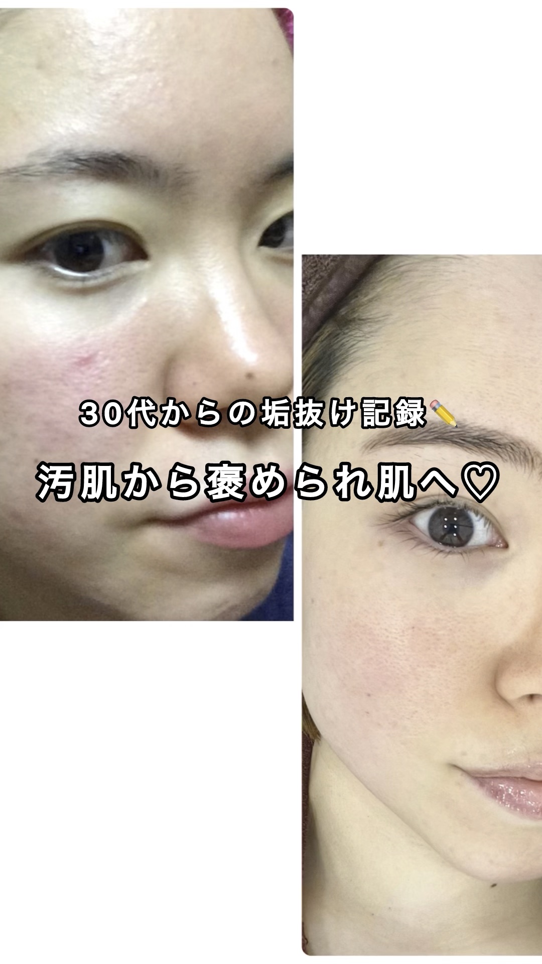 私の垢抜け記録✏️

汚肌から褒められ肌までの道のり編！
✼••┈┈••✼••┈┈••✼••┈••✼
これは本当に戦ったし辛かった。。
肌が汚すぎてネットに悪口を書かれたこともある私。
でもすぐに改善なんてできない😭
アトピー、敏感肌、ニ