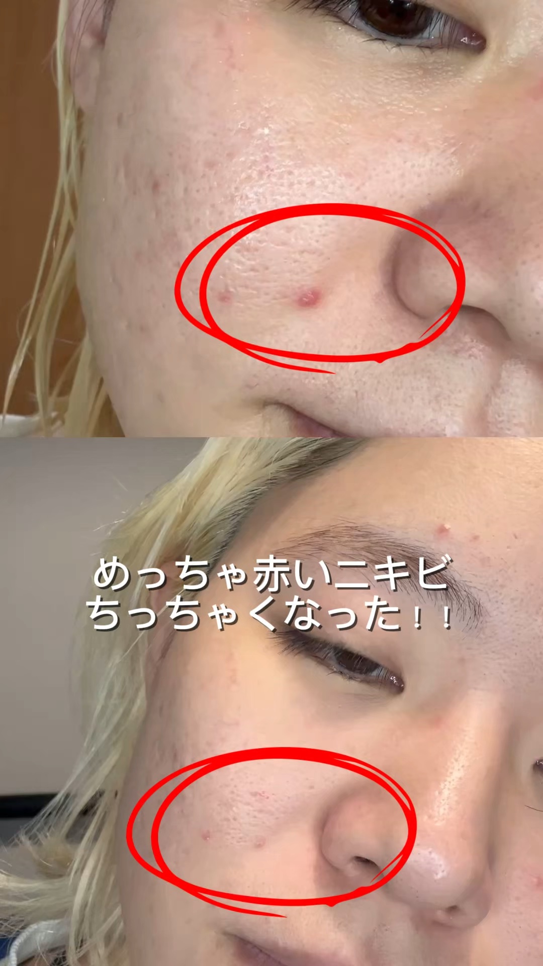 エーキュアスピキュールスポット/obsero/フェイスクリームの動画クチコミ2つ目