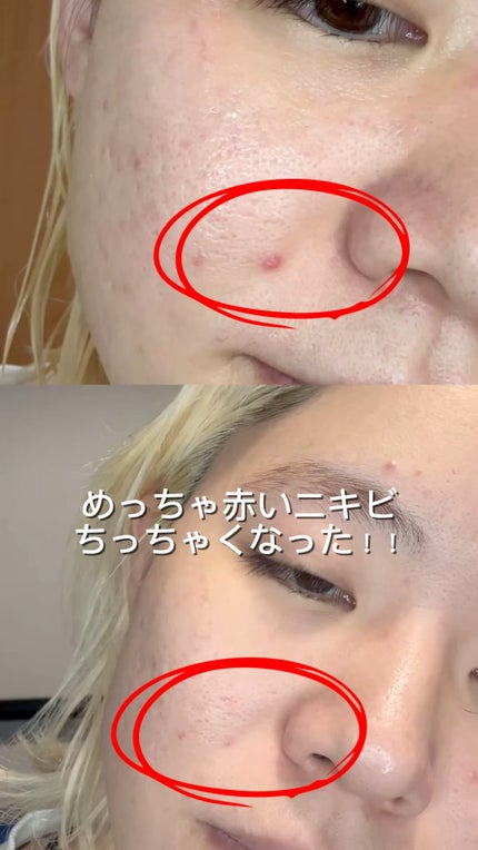 エーキュアスピキュールスポット/obsero/フェイスクリームの人気ショート動画