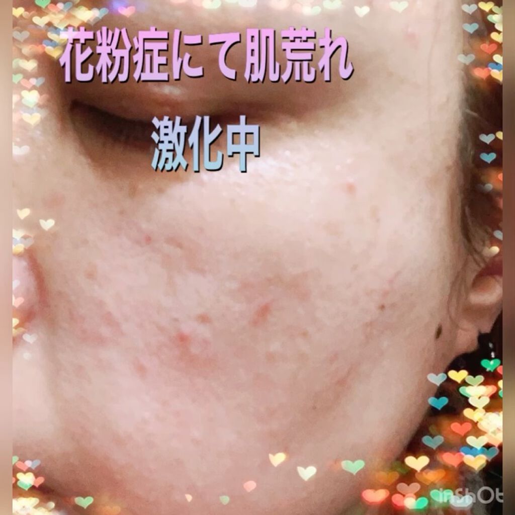 リアルカバーリキッド ライトグロウ Kateを使った口コミ 花粉症や ニキビや イボで 皮膚科に行き By リサ ラーソン Lips