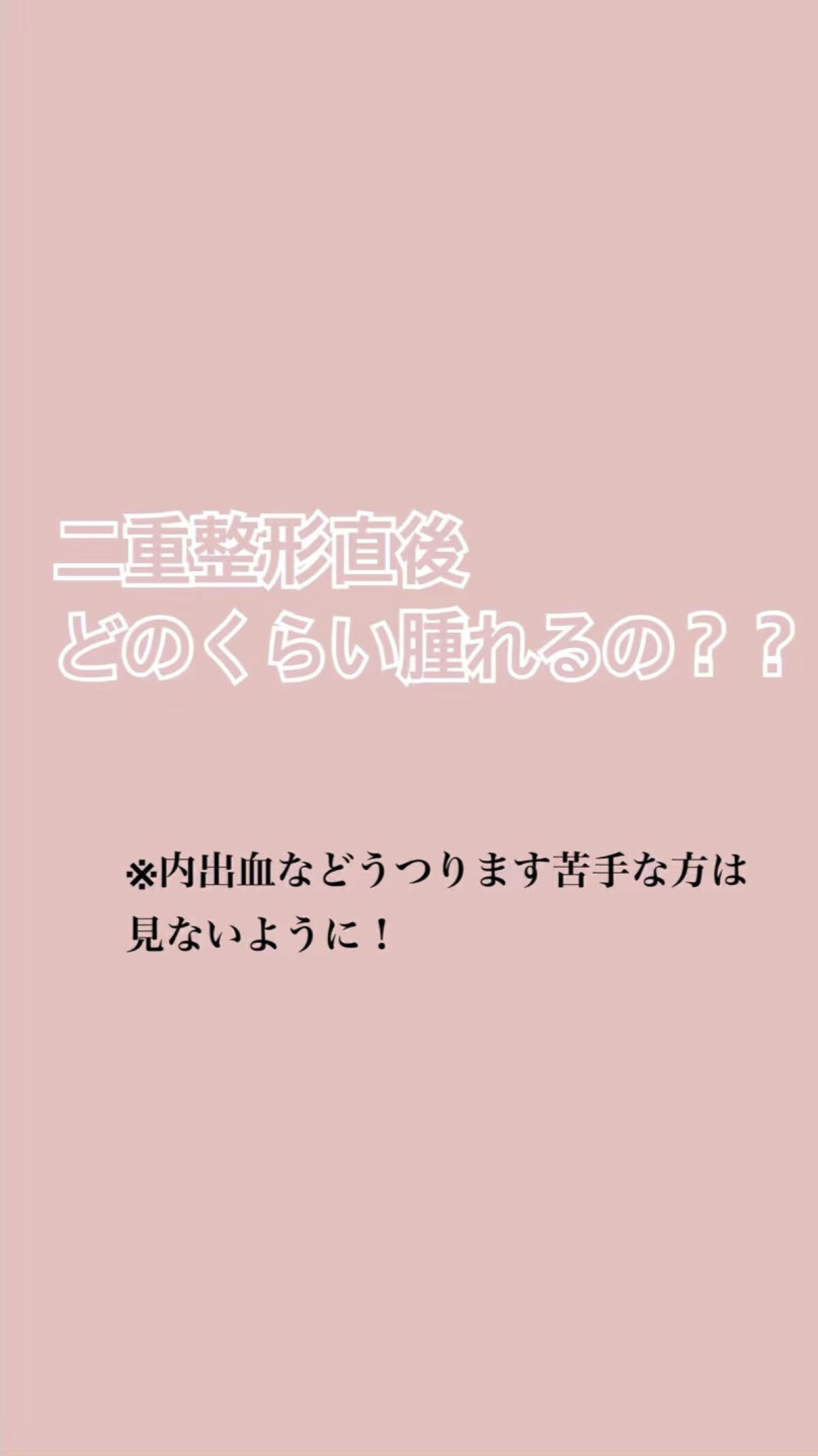 今回片目埋没(2点留め)直後の比較動画です。
