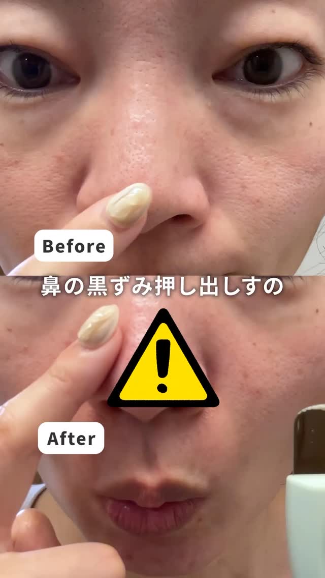 ILSO　スーパーメルティング セバムソフトナー/ilso/化粧水の人気ショート動画