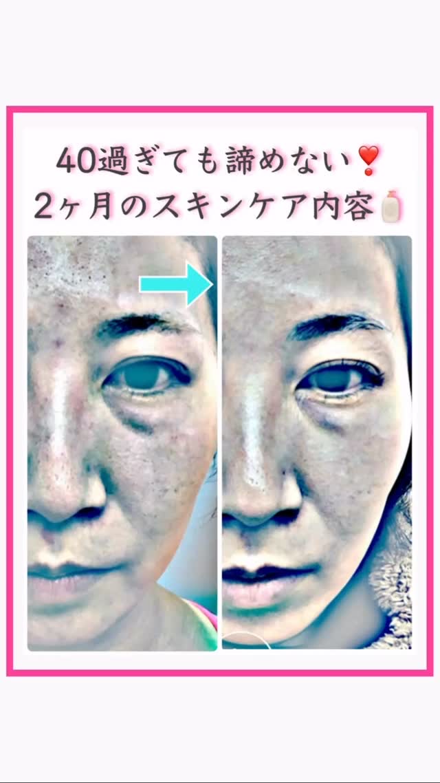 ストーリーで10月からの変化を流してきたので
完全にネタバレですが
途中経過抜きの2ヶ月前と現在の肌変化を
自分用記録として残しておきます📝

ご存知のように昔から
致死量のスキンケア用品を毎日使う人なので
10月までがサボってた訳でも何