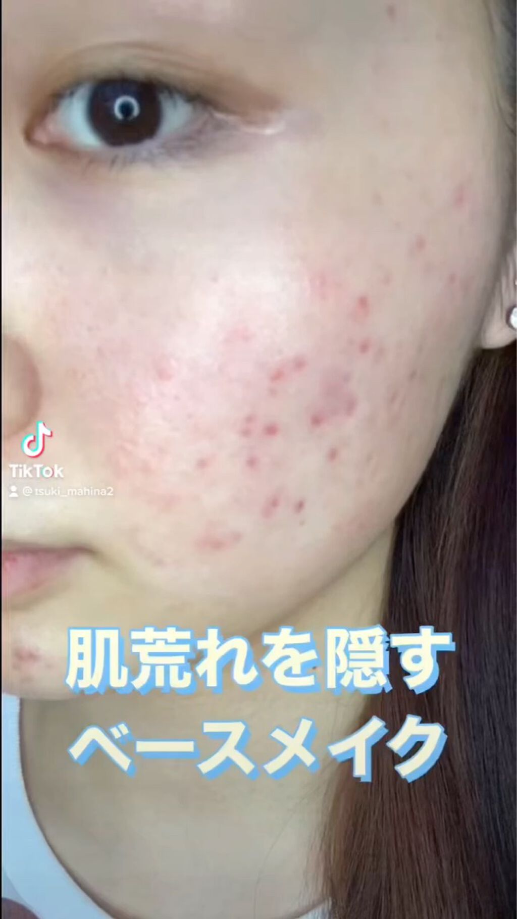 TikTokで11K以上再生して頂けた『肌荒れを隠すベースメイク』


是非参考にして頂けたら嬉しいです😌🌿


YouTubeもやっているので是非チャネル登録よろしくお願いします🕴🏻


#ニキビ跡 #ニキビ
#肌荒れ　#肌荒れメ