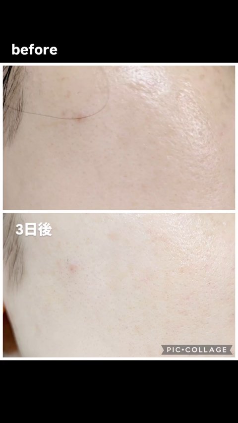 DERMAGENCY
ゼロカ81 クリーム✨

@dermagency_jp 

全国のクリーム難民におすすめ！
肌荒れ、ニキビ、敏感肌時のレスキュークリーム♥

ジェルのようなテクスチャで、
のびが良いのに軽すぎずプルンとした肌に✨

最