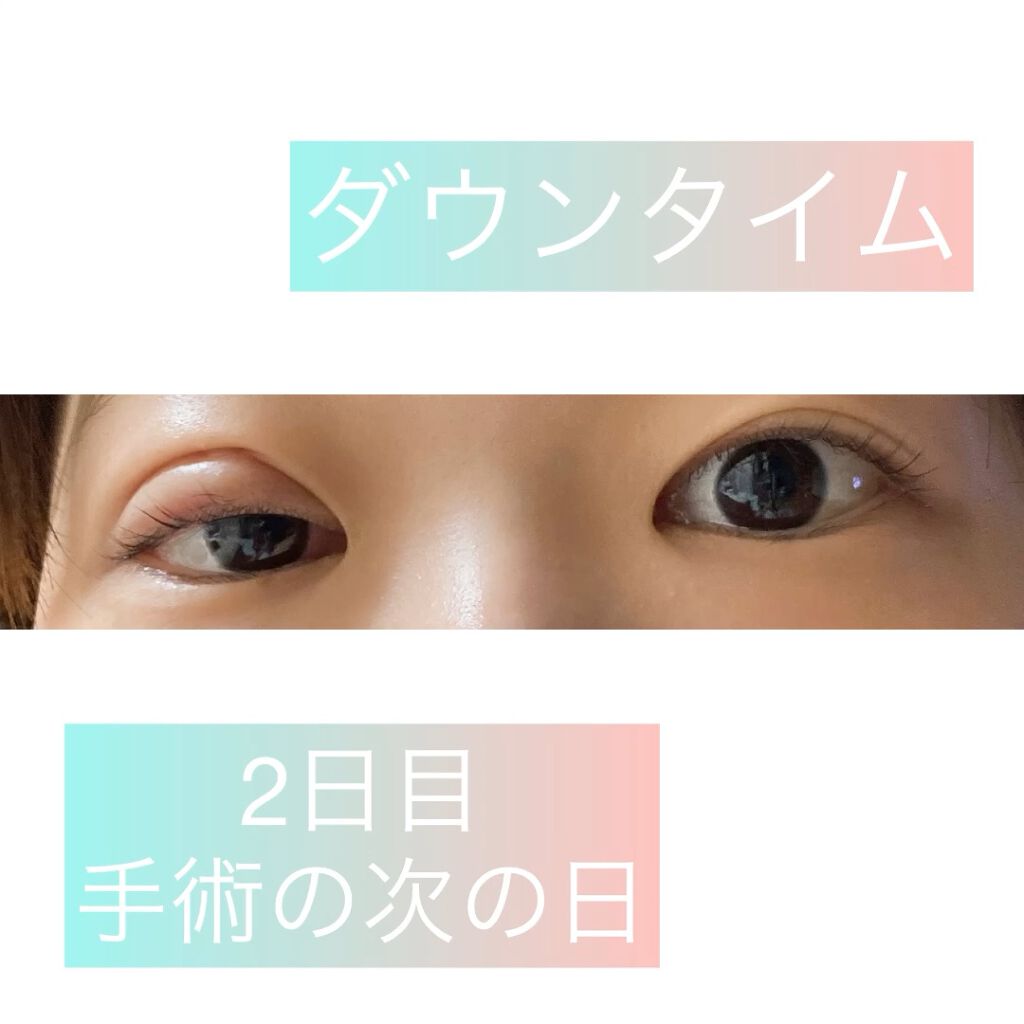 二重整形/その他を使ったクチコミ（1枚目）