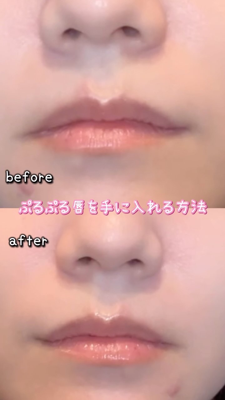 デイニードルリップ/CHOOSY/リップ美容液を使ったクチコミ（1枚目）