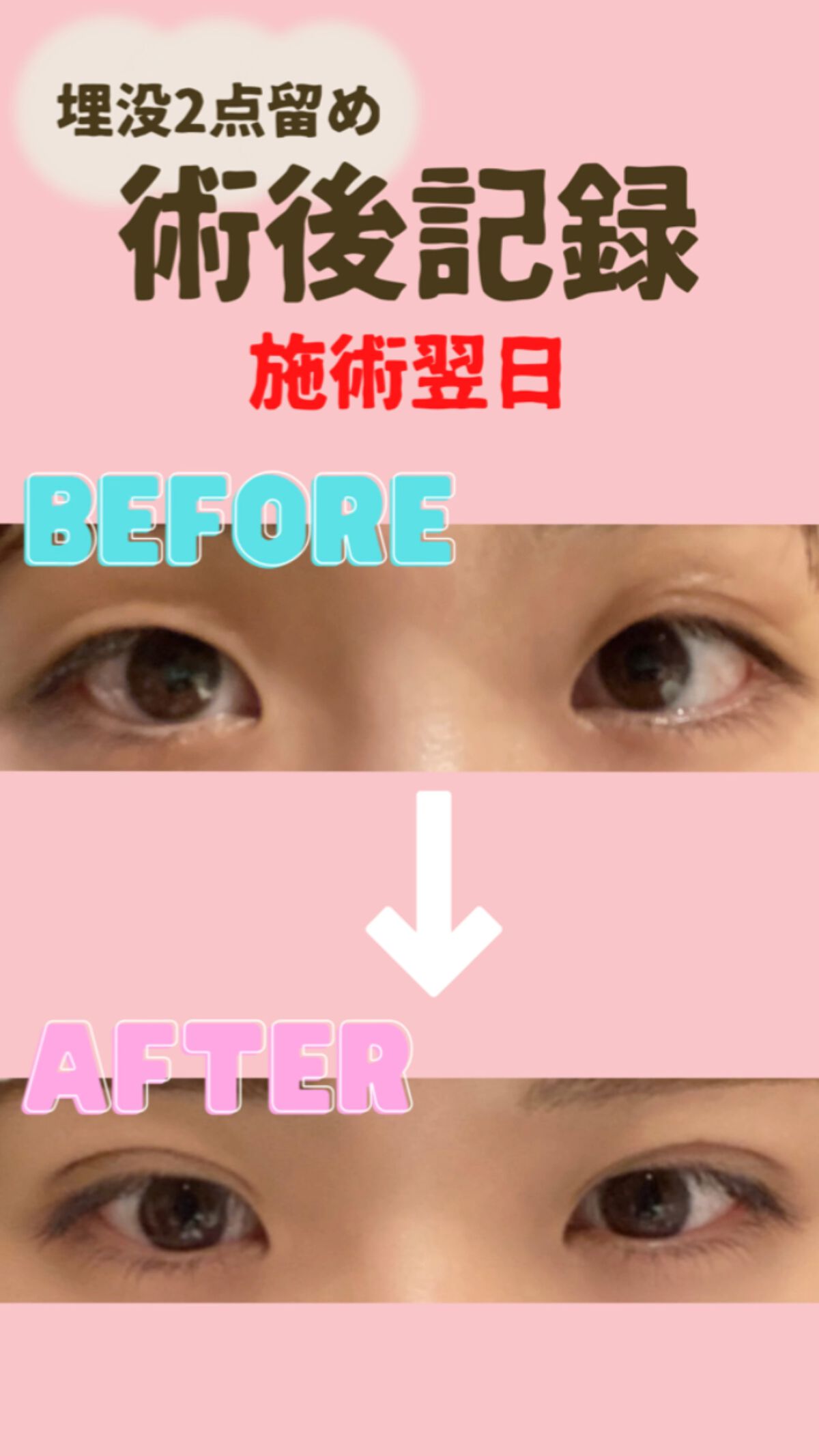 埋没後2日目1番腫れる🥹
✼••┈┈••✼••┈┈••✼••┈┈••✼••┈┈••✼

埋没施術の翌日の様子をレポします👀✨

術後思ったより腫れてなくて、
アザも目立たなかったから、
このまますぐに自然になるんじゃないかしら😳
と思