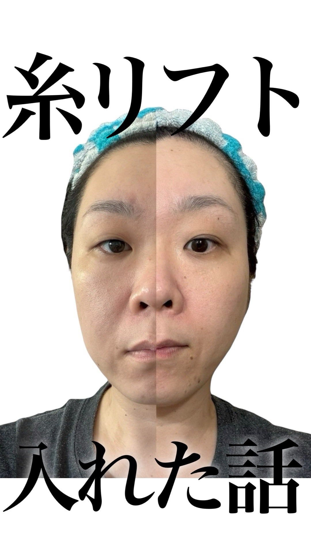 糸リフト入れました！入れてから4週間経過。自分の輪郭に脂肪がフィットしてきた感じ。
・カウンセリングは妥協せずに数件受けてみて、定評のある執刀医探しは大事！
【自分の感想】
・垂れてからでは色々大変なので、垂れる前から下垂と向かい合うことが