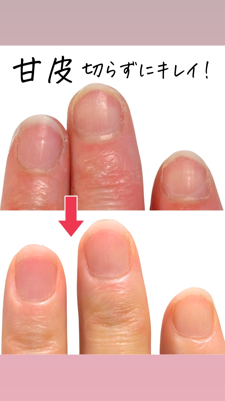 「甘皮＝切らないとダメ」
そう思っている人、実は多いです。

でもこの甘皮、
実はニッパーで切っていません。

ガーゼでやさしく押し上げて
毎日しっかり保湿するだけ。

切らないから
✔ 切りすぎない
✔ ケガしない
✔ 荒れにくい

乾燥