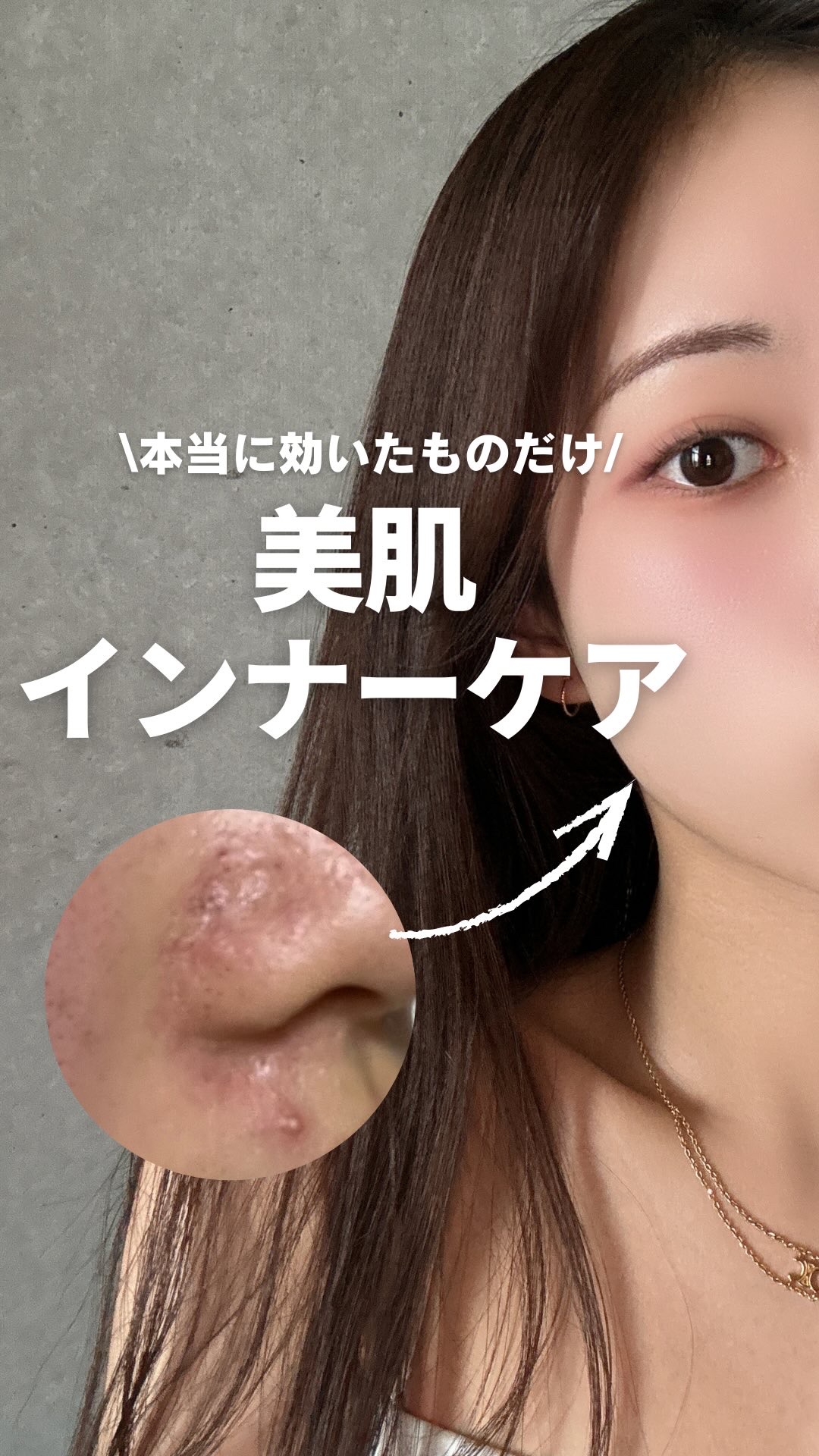 ・
白湯です🫶🏻
今回は一番肌が変わった「インナーケア」を紹介！

肌は食べたものに影響されるって言うけど、
正直漢方とかサプリって効果が分かりにくくて続けづらい...

だから、10年ニキビに悩み続けた私が本当に効果を感じたものだけ紹