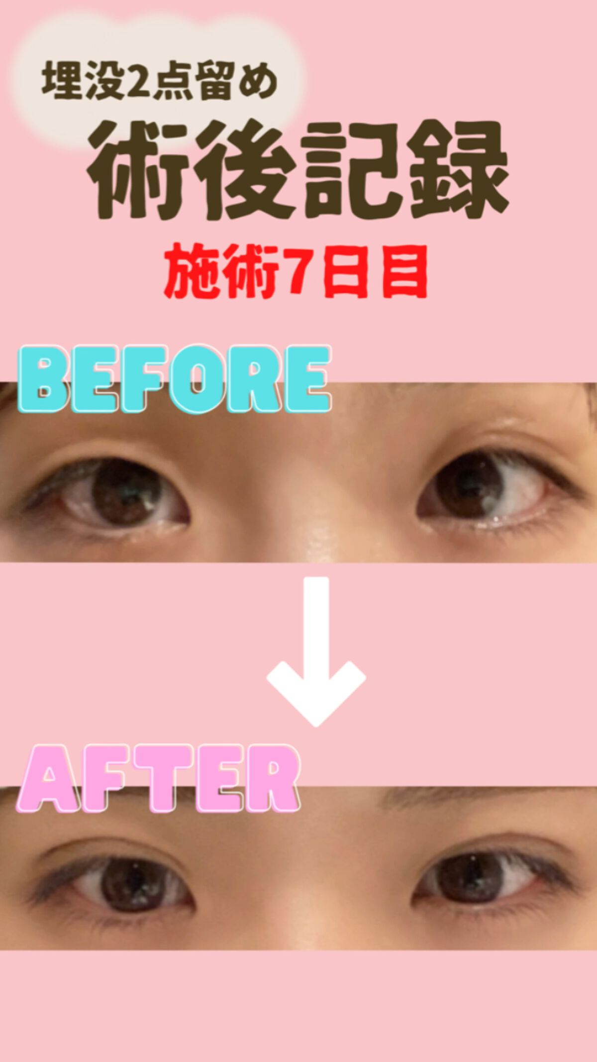 ついに施術後1週間✨
✼••┈┈••✼••┈┈••✼••┈┈••✼••┈┈••✼      

1週間経ちました〜！
1週間は一つの区切りらしくて、
腫れとかむくみが少し落ち着いてくるタイミングらしい🌷

私の場合は左目は落ち着いてきたけ