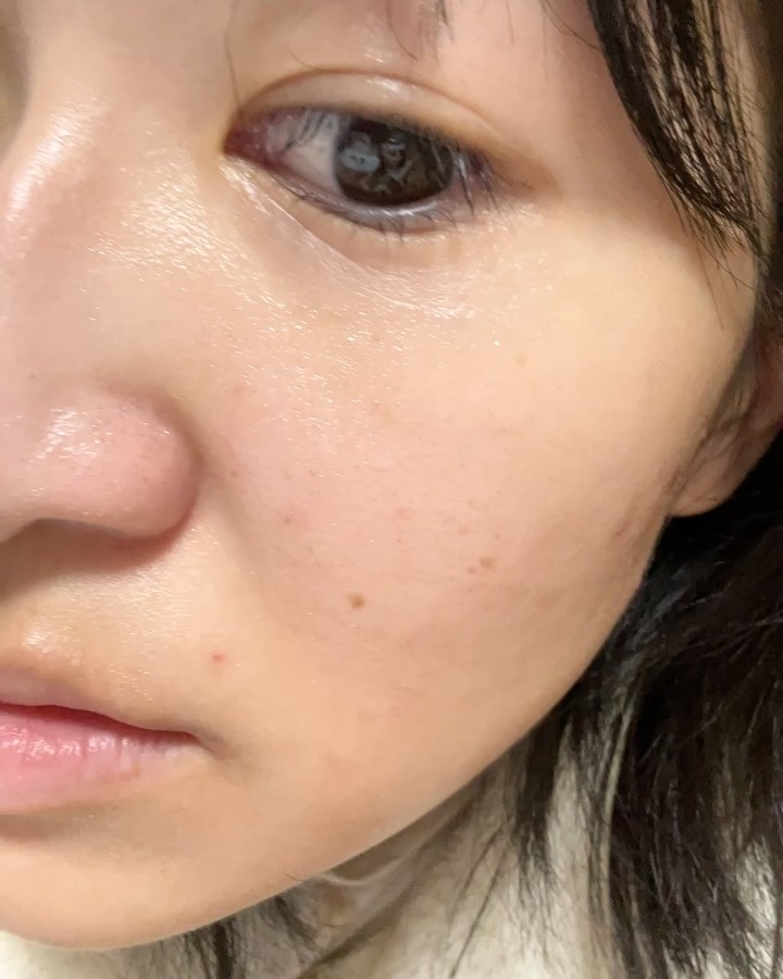 アゼライン酸 トナーパッド/LEPOREM/トナーパッドの動画クチコミ4つ目