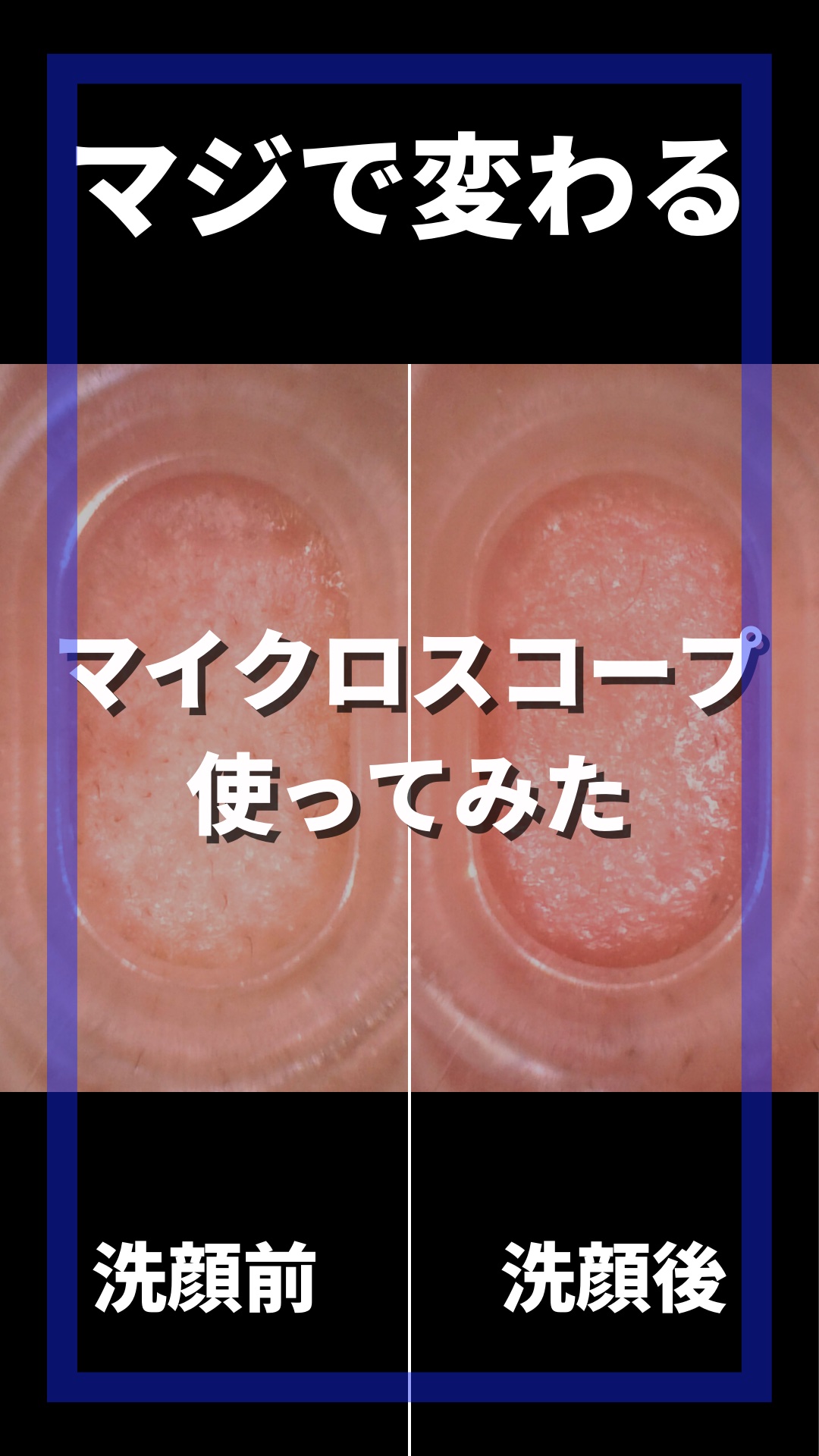 アレティ ポアスコープ/Areti./美顔器・マッサージを使ったクチコミ（1枚目）