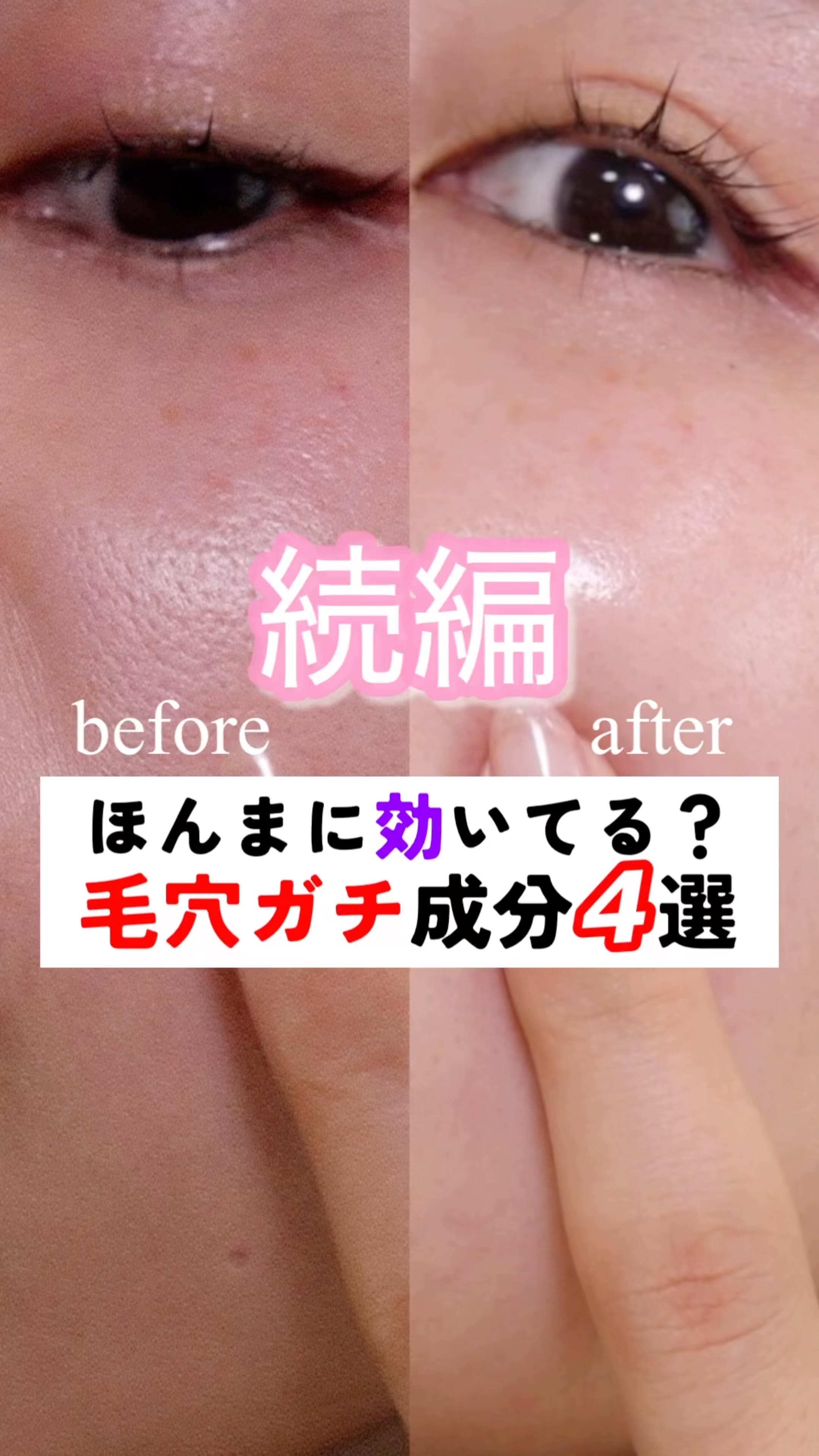 毛穴って“消す”んやなくてボカすスキンケア！
大人になると、毛穴が影みたいに目立つけど
実は「光を乱反射させる肌」に整えると、
毛穴は“見えにくく”できるねん。すごいやろ？

今回はそんな“ぼかし美容”の成分を4つ厳選！

・ナイアシンアミ