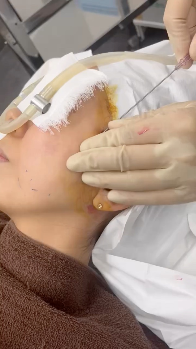 ２年ぶりの糸リフト。
やっぱりめちゃくちゃ上がるし、凄く満足度の高い施術だなーって思います。

局所麻酔乗り越えたら、本当に痛くないので
見た目より怖くないですよ！

#糸リフト　#美容医療