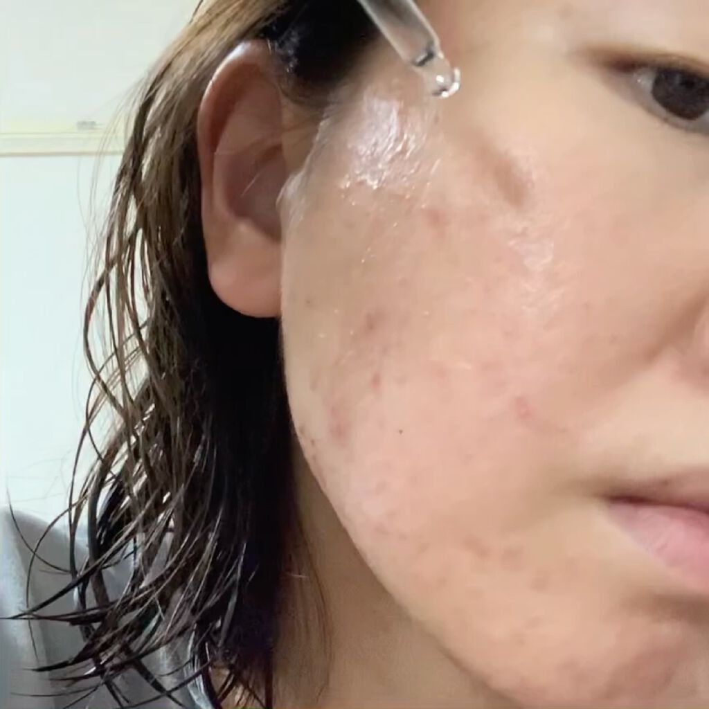 AZアゼライン酸10セラム/コスデバハ/美容液を使ったクチコミ（2枚目）