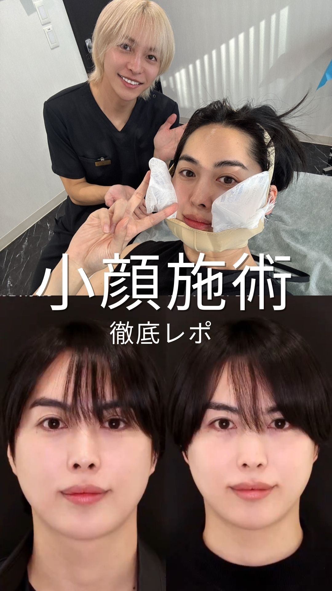 顔の脂肪のもたつきが気になっていたので大親友のDr.もりもりに小顔施術してもらいました！

今回した施術の内容は

・ジョールファット除去
・頬脂肪吸引
・系リフト
・ヒアルロン酸（顎に1Cc）

実は小顔系の施術は2回目だったため
もりも