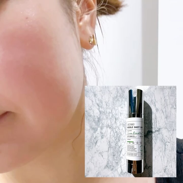 リードルショット300/VT/美容液を使ったクチコミ（3枚目）