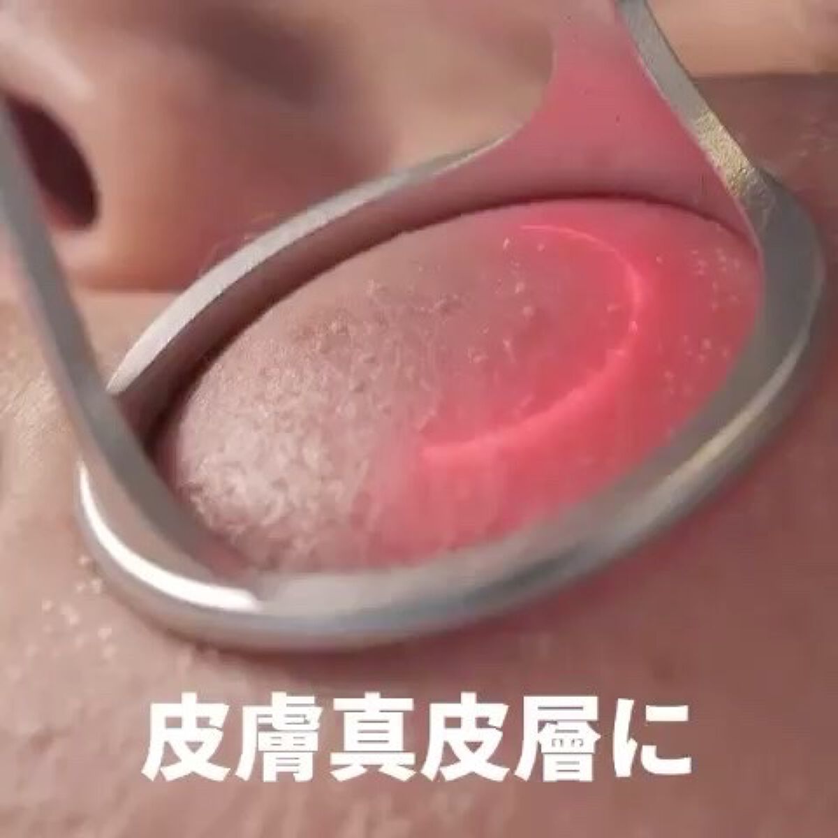 BP角質ケアトナーパッド/Dr.Melaxin/トナーパッドの動画クチコミ4つ目