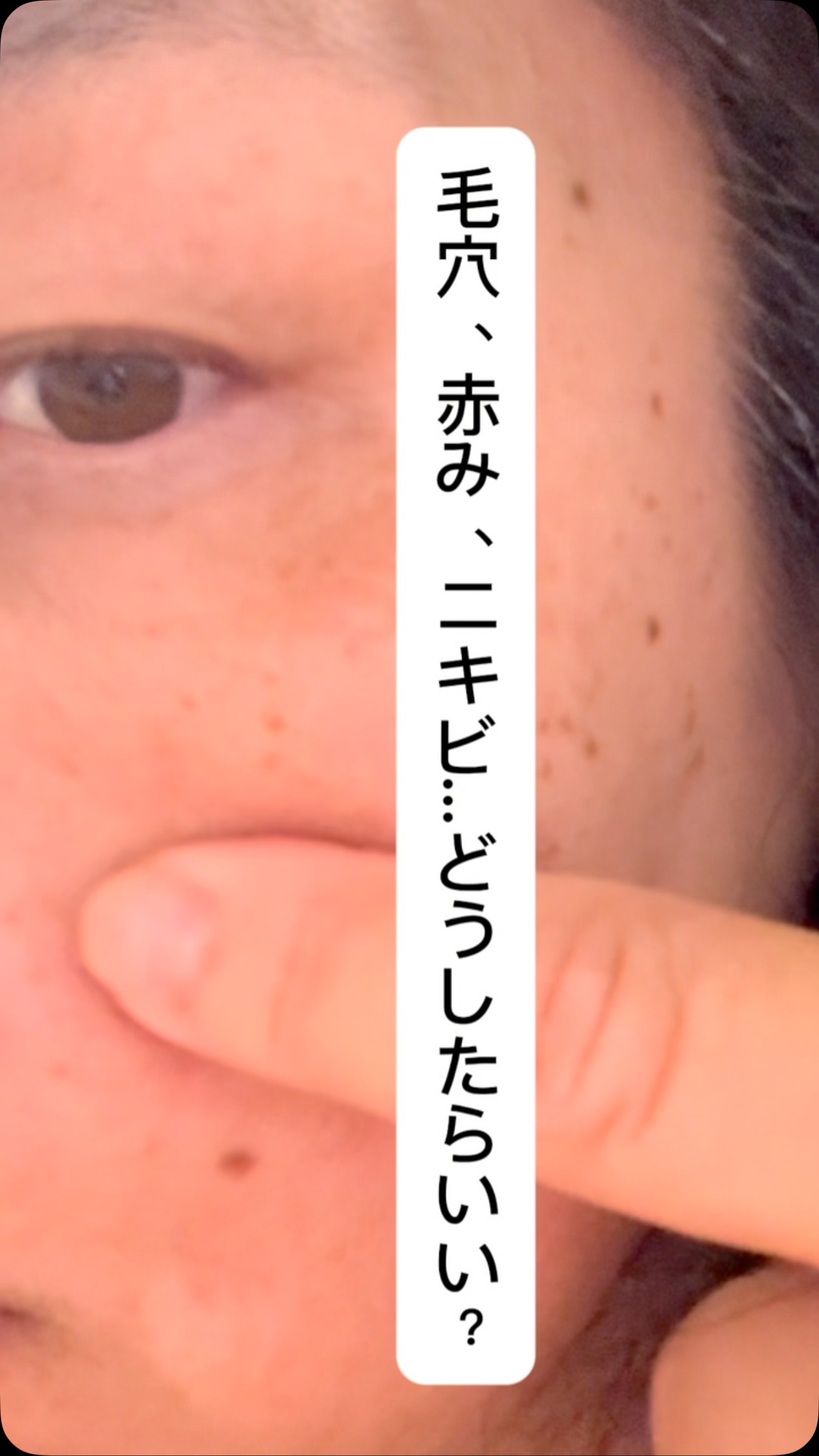 AZアゼライン酸10セラム/コスデバハ/美容液の人気ショート動画