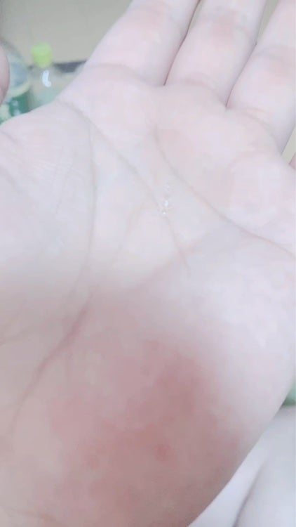 ダーマレーザー スーパーVC100ローション(しっとり)/クオリティファースト/化粧水を使ったクチコミ(2枚目)