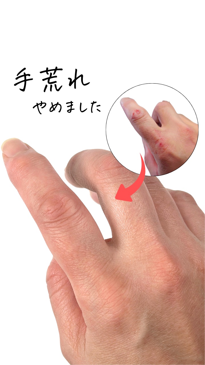 クリーム塗ってるのに、手荒れが全然よくならない…
そんな“冬あるある”に心当たりありませんか？🥲

実はそれ、
肌の中の水分が足りていないサイン。

クリームは「保湿」ではなく
水分が逃げないようにする“フタ”の役割。
だから、フタの下に