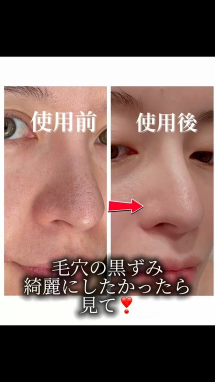 弱酸性毛穴収縮ニドソープ/ODELOI/その他洗顔料を使ったクチコミ(1枚目)