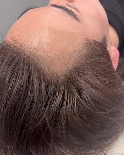 ヒロキ|40歳の美容家 ヘアケア スキンケア on LIPS 「やりました!美容医療レポ。生え際アートメイク🪡 昔から生え際に..」(4枚目)