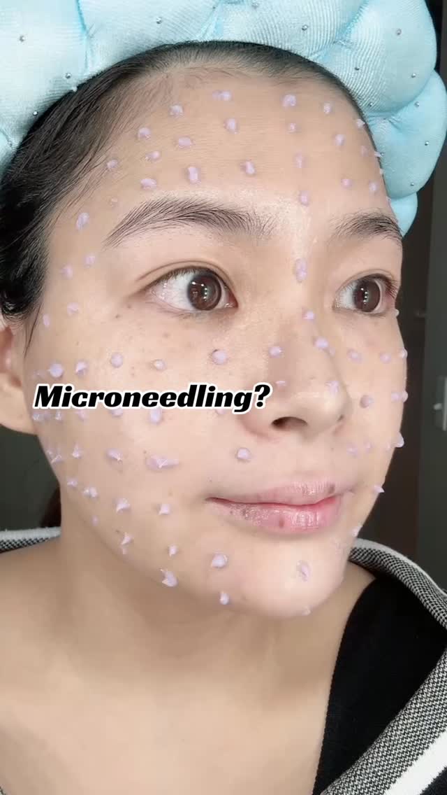 敏感肌のためのニードル💜
ニードルクリームは初めてで緊張したけど
敏感肌に適してるって説明を信じてお試ししました！
クリームを伸ばすときにチクチクはしたけど
問題なく使えた✨
敏感肌でもニードルに挑戦してみたい方にオススメ💜

#mar