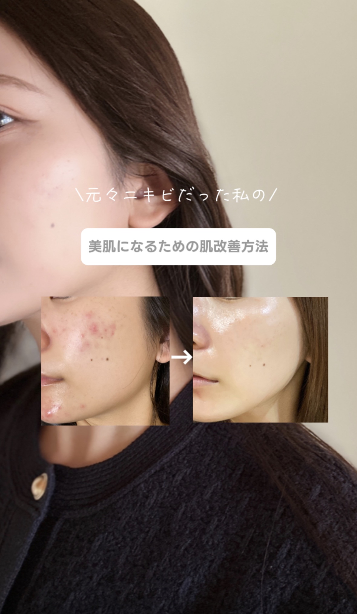 アトバリア365クリーム/AESTURA/フェイスクリームを使ったクチコミ（1枚目）