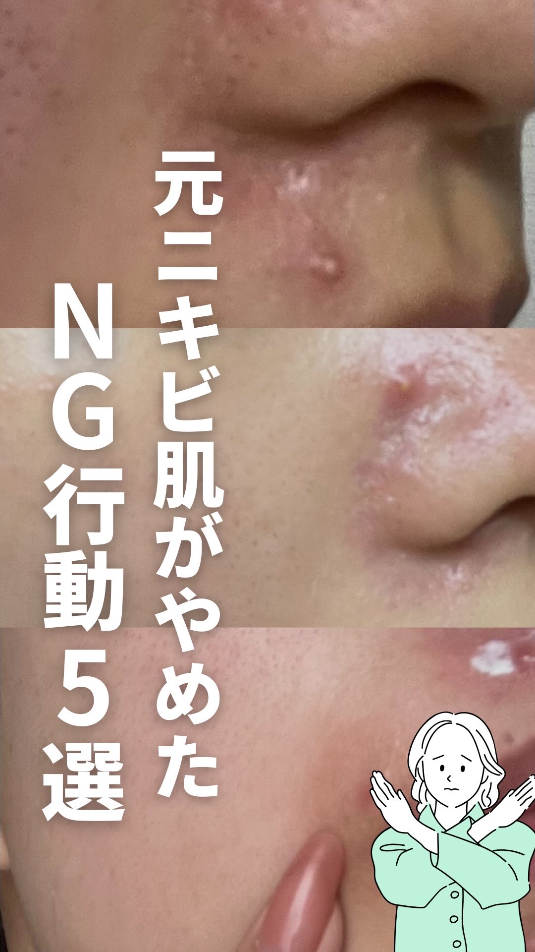 .
白湯です！
もともと一生治らないと思ってたニキビ肌だったけど
ここまで綺麗になったから全部公開します！！
.
みんなの力に少しでもなれたらいいな🥺
.
みんなはどの場所にニキビできやすい？
コメント欄で教えてね🫶🏻
⁡
この投稿を