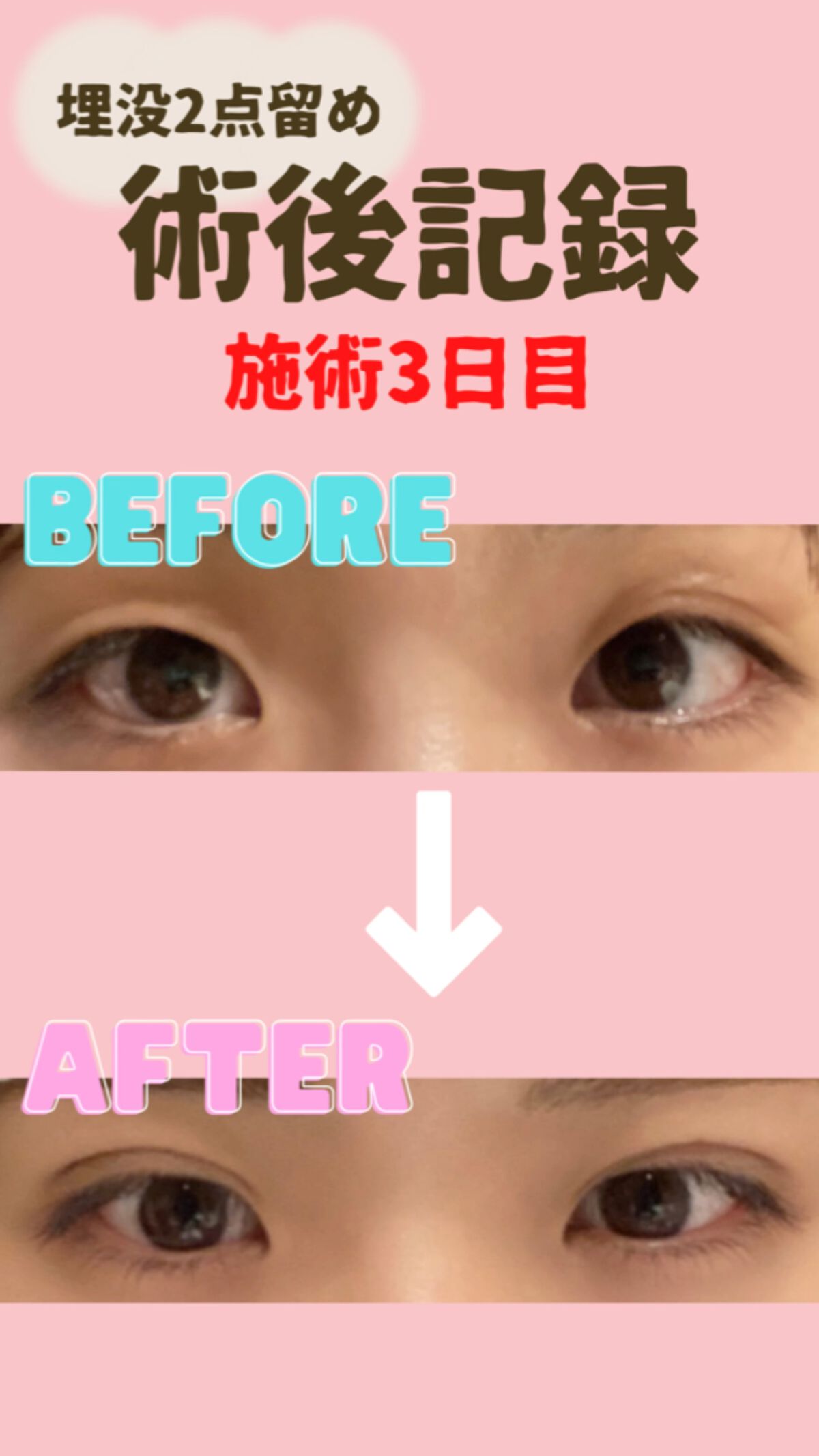 DT3日目🤔🤔🤔
✼••┈┈••✼••┈┈••✼••┈┈••✼••┈┈••✼

毎朝目どうなってるかな〜と楽しみな
おんまゆです🌱

DT3日目ですが、腫れてる〜！！！😭😭

目が腫れてると、希望の仕上がりと違いすぎて
少し気分