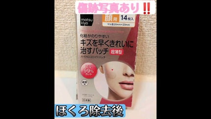 キズを早くきれいに治すパッチ/matsukiyo/その他の人気ショート動画
