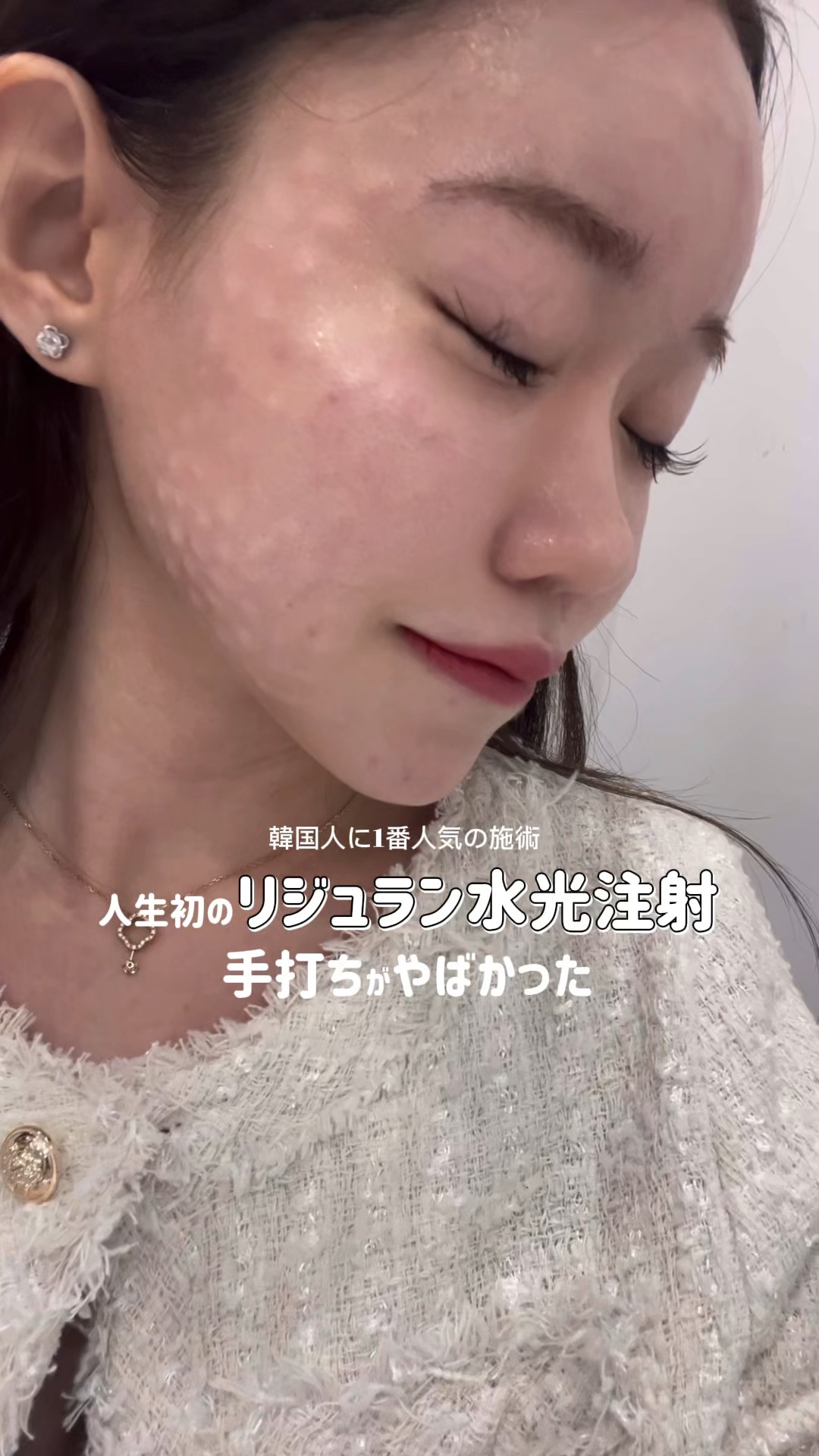 人生初手打ちリジュランレポ！！！！痛すぎて大泣き案件( Ĭ ^ Ĭ )

#リジュラン#リジュランヒーラー #ブルベ#ブルベ夏 #メガポ #韓国メイク #韓国コスメ #韓国スキンケア #乾燥肌 #韓国美容 