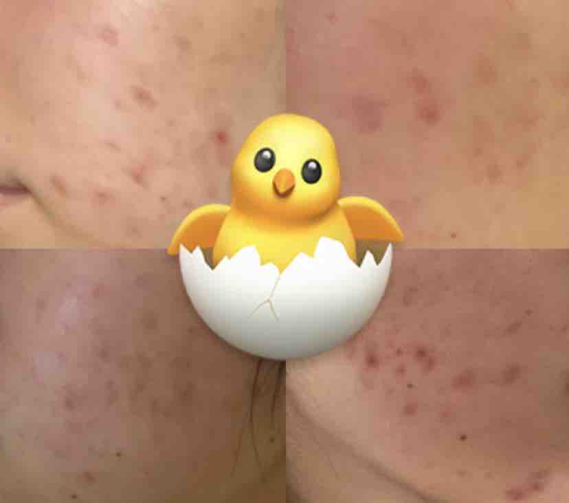 「肌荒れ治すぞ」ひよこ🐣フォロバ100